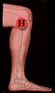 Knee Pain Right Side Tx